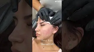 Foxy Eye Thread Lift by Dr Gideon Kwok at Skin Perfect Rancho 🪡 