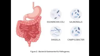 Bacterial Gastroenteritis ; Definition, Causes, Symptoms, Diagnosis, Treatment