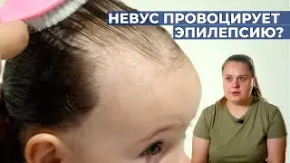 МЕЛАНОФОРМНЫЙ НЕВУС | История Есении Стройкиной