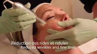 Traitement ACS-PEN Microneedling - EQlib Medispa