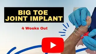 Big Toe Joint Implant 4 Weeks Out | Dr. Kevin Lam | Top Podiatrist #bigtoesurgery #toppodiatrist