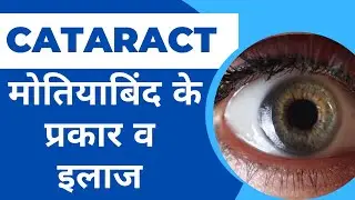 मोतियाबिंद (cataract) : लक्षण, कारण, उपचार