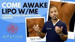 Come Awake Lipo with Me: Double Board-Certified Plastic Surgeon goes over what Awake Lipo is Live