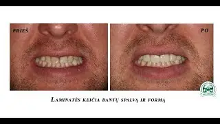 Dantų laminatės | Dažniausiai užduodami klausimai. 2 dalis.