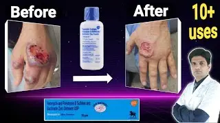 गहरे घाव के लिए एंटीबायोटिक पाउडर, क्रीम | Neosporin skin oinrtment uses in hindi