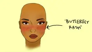Do I Have Lupus - Common Signs and Symptoms on LupusChick.com