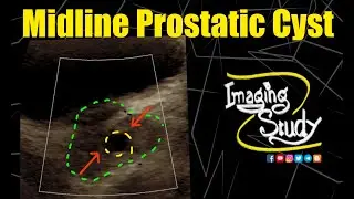 Midline Prostatic Cyst || Ultrasound || Case 302