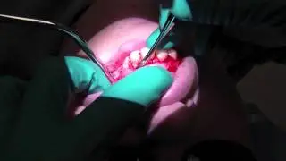 Apicoectomy Flap Elevation