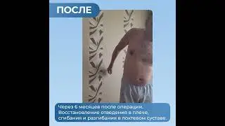 Травма плечевого нервного сплетения. Результат лечения в НИИ Микрохирургии г.Томск
