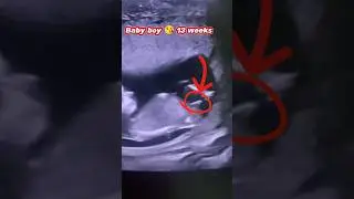 Baby boy, ultrasound does 360 spin in mom Belly#pregnancy #baby #shorts