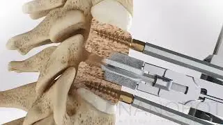 Orthopedic, Sports Medicine, Joint and Trauma Animation Showreel Nanobot Medical