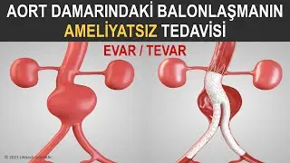 EVAR/TEVAR | Aort Anevrizmasının Ameliyatsız Tamiri
