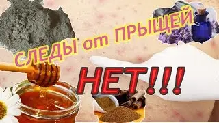 КАК ИЗБАВИТСЯ от СЛЕДОВ после ПРЫЩЕЙ?
