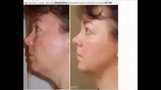 Микроэмульсия для разглаживания глубоких мимических морщин