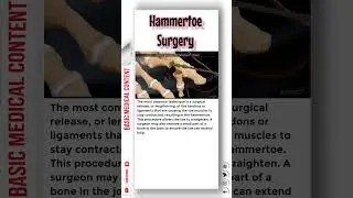 Hammertoe Surgery 