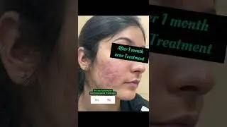 Before and After Hormonal Acne Treatment 