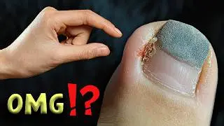 🍄 ЧТО С НОГТЕМ?! 😅 Врослый ноготь.ЧТО ДЕЛАТЬ?БОЛИТ УГОЛОК.ПОМОЩЬ в ДОМАШНИХ УСЛОВИЯХ.Педикюр ОШИБКИ