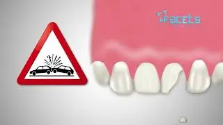 Root Canal Treatment Cost in Kochi, Kerala