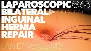 Pediatric Laparoscopic Bilateral Inguinal Hernia Repair - Dr. James Wall