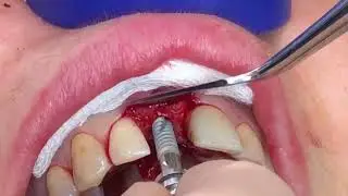 Implant Placement  with Bond Apatite