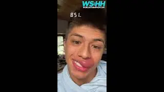 Dude's Lips Quickly Went From Bad To Worse After Getting Stung By A Wasp