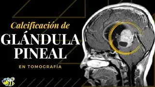 Calcificación de glándula pineal en tomografía