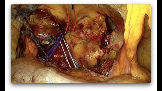 TAPP for left inguinal hernia - Ernioplastica laparoscopica TAPP per ernia inguinale sinistra