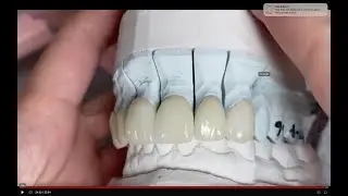 Veneers Simple Buildup Grind Glaze #6 #11