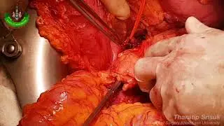 Posterior Radical Antegrade Modular PancreatoSplenectomy (RAMPS)