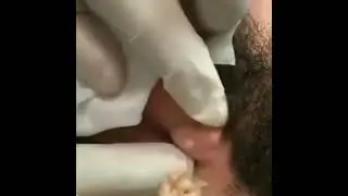 прыщи давить. огромный прыщ на мошонке!!! жесть!!!