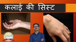 कलाई-की-सिस्ट Wrist Ganglion Cyst Hindi.