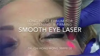 Fotona SmoothEye Laser