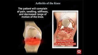 Knee Pain , knee Arthritis. what is knee arthritis ?
