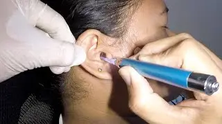 Removing Earwax Chunk Stuck in Woman's Ear