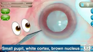 Small pupil, white cortex, dark nucleus Phaco time.