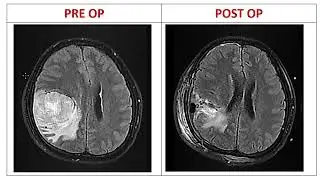 Tumor of right parietal-temporal region of the brain.