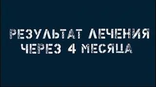 Первичная эндодонтия 27 зуба 4 канала