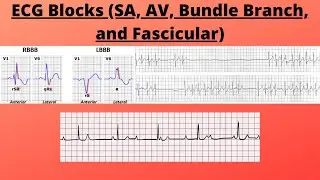ECG Blocks (Sinus exit block, sinus arrest, AV blocks, Bundle Branch blocks, and Fascicular blocks)