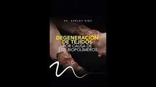 Los biopolímeros destrozaron sus piernas