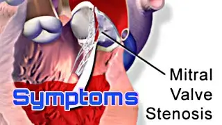 Mitral Valve Stenosis|Symptoms|knowledge madnoob