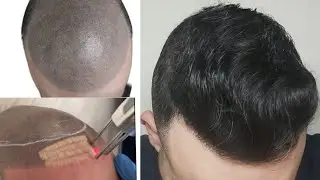 CASO ÚNICO - micropigmentación + injerto capilar // alopecia avanzada N-VI