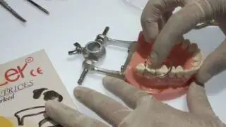 ADDLER CONTOURED METAL MATRICES