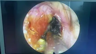 Earwax, also known  cerumen, is a waxy substance secreted in the ear canal of humans.