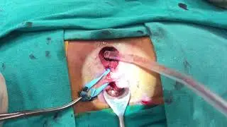 Dr. Sezai Leventoğlu-Nüks atnalı fistül