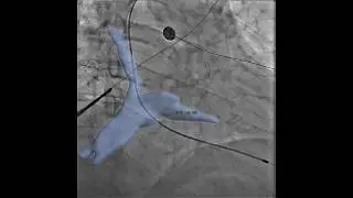 3D XRay reconstruction in Biotok Unity XR