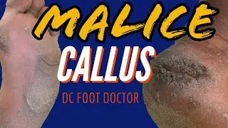 Malice Callus: Severe Calluses and Fissures  (Size 13 Feet)