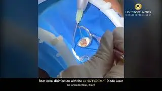 Root canal disinfection with the D-Storm™ Diode Laser