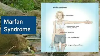 Marfan Syndrome Symptoms | What Is Marfan Syndrome