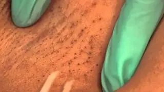 Tweezing the Underarms : Waxing & Tweezing