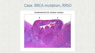 Extra-uterine high-grade serous carcinoma: closing the loop?